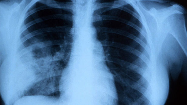 Lung X-ray Spot