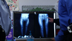 Mexican Children with disabilities travel to the U.S. for Medical care.