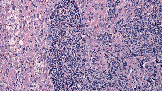 Histology Glioblastoma with primitive neuroectodermal tumor (PNET) component, HE stain, x100 magnification. Source: Wikimedia Commons.