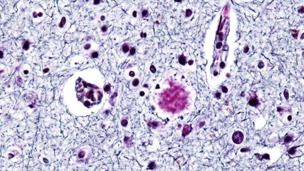 Histopathologic confirmation of a presenile case of definite Alzheimer's disease.