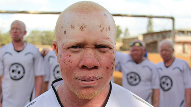 Nasoro is a member of the Albino United Football team. Nairobi, Kenya.