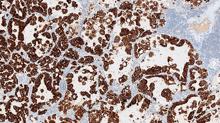 Non-small cell lung cancer tissue stain