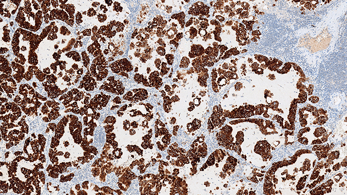 Lung cancer stain