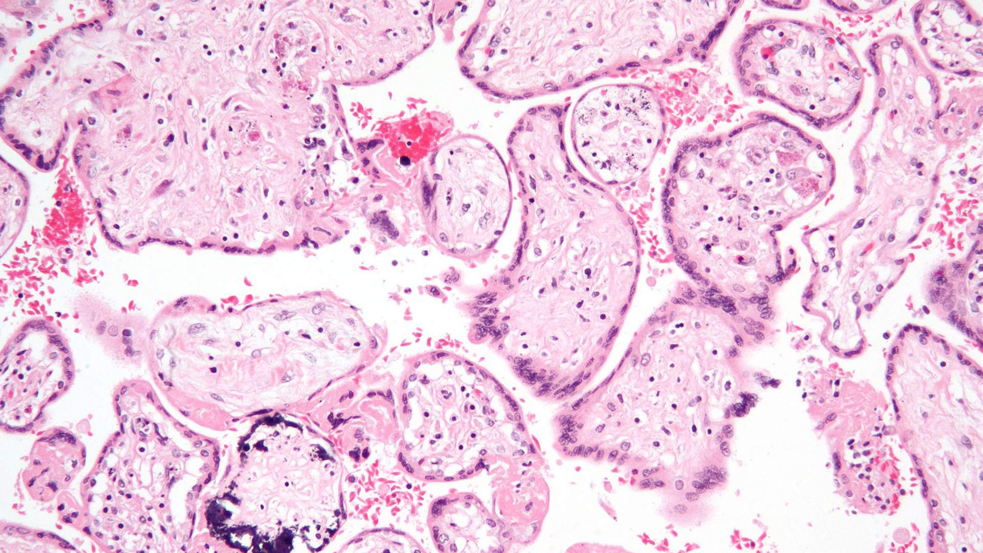 A photograph of Cytomegalovirus placentis. 