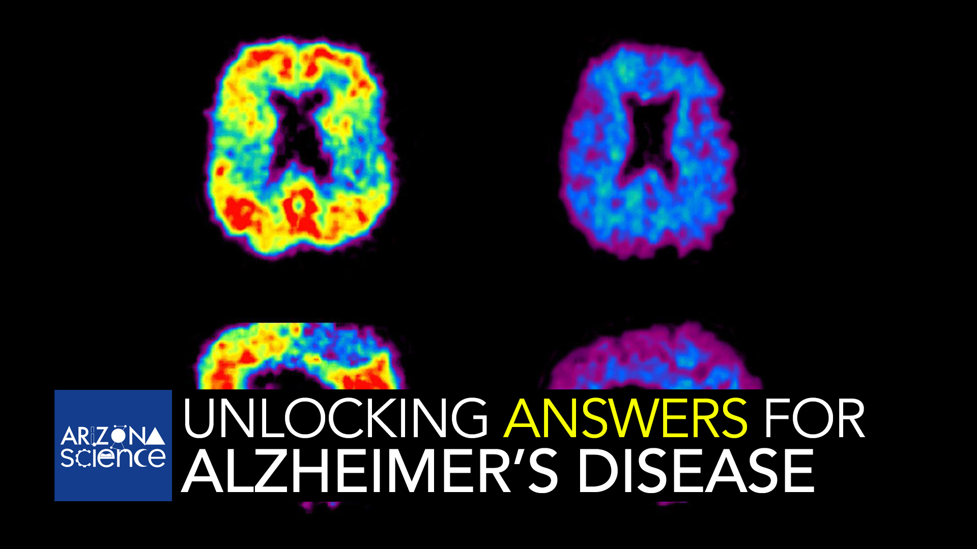 This image shows a PiB-PET scan of a patient with Alzheimer's disease on the left and an elderly person with normal memory on the right. Areas of red and yellow show high concentrations of PiB in the brain and suggest high amounts of amyloid deposits in these areas.