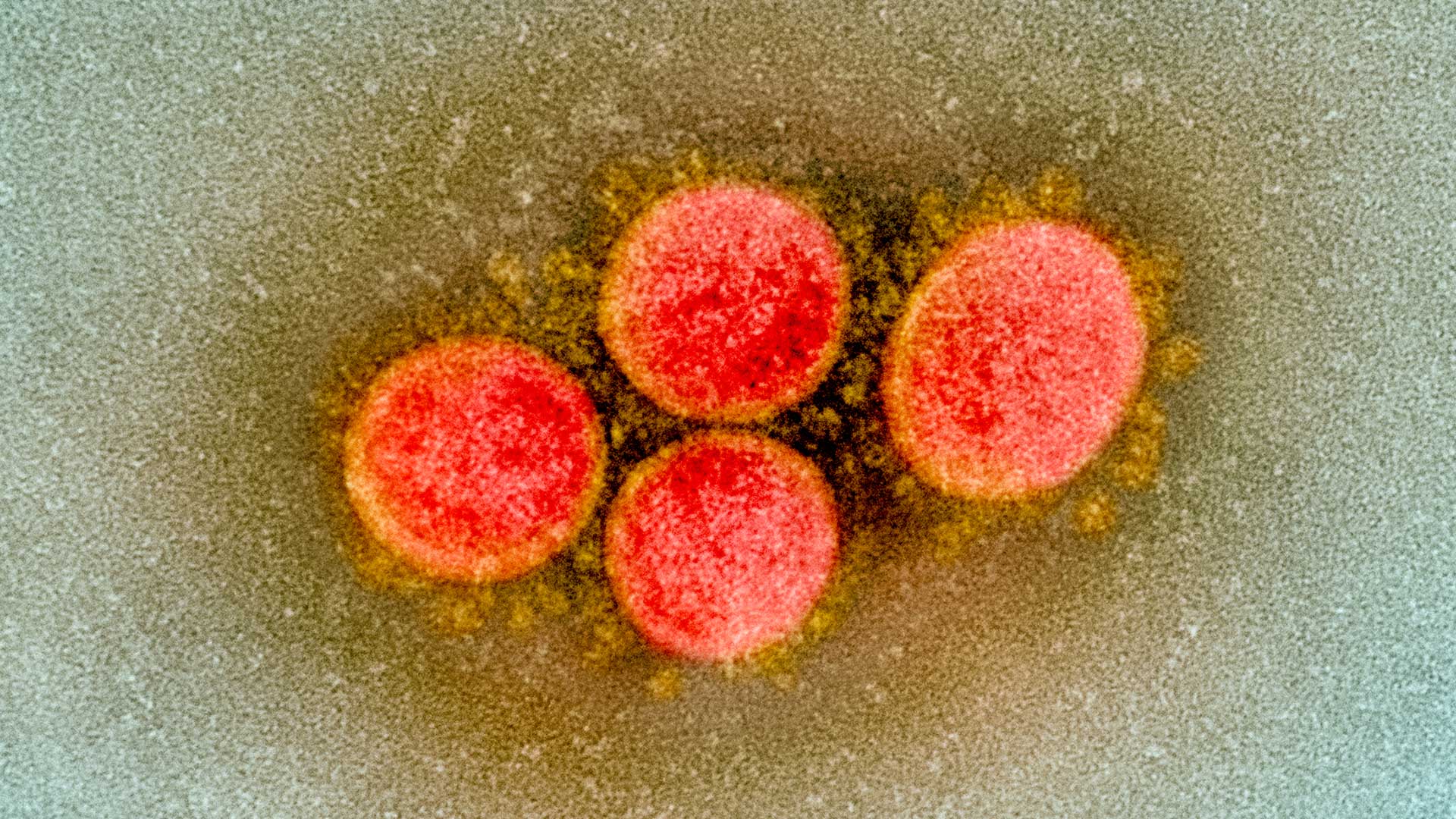 Transmission electron micrograph of SARS-CoV-2 virus particles, isolated from a patient. Image captured and color-enhanced at the NIAID Integrated Research Facility (IRF) in Fort Detrick, Maryland.