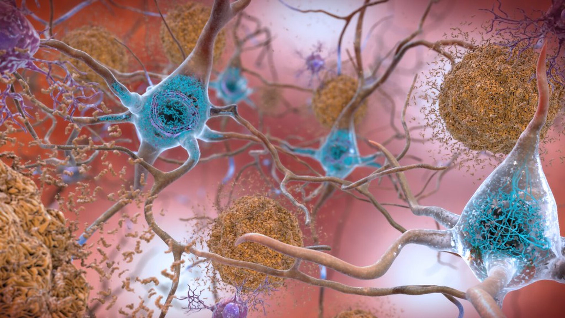 Tangled proteins in the Alzheimer's affected brain harm communication between nerve cells.