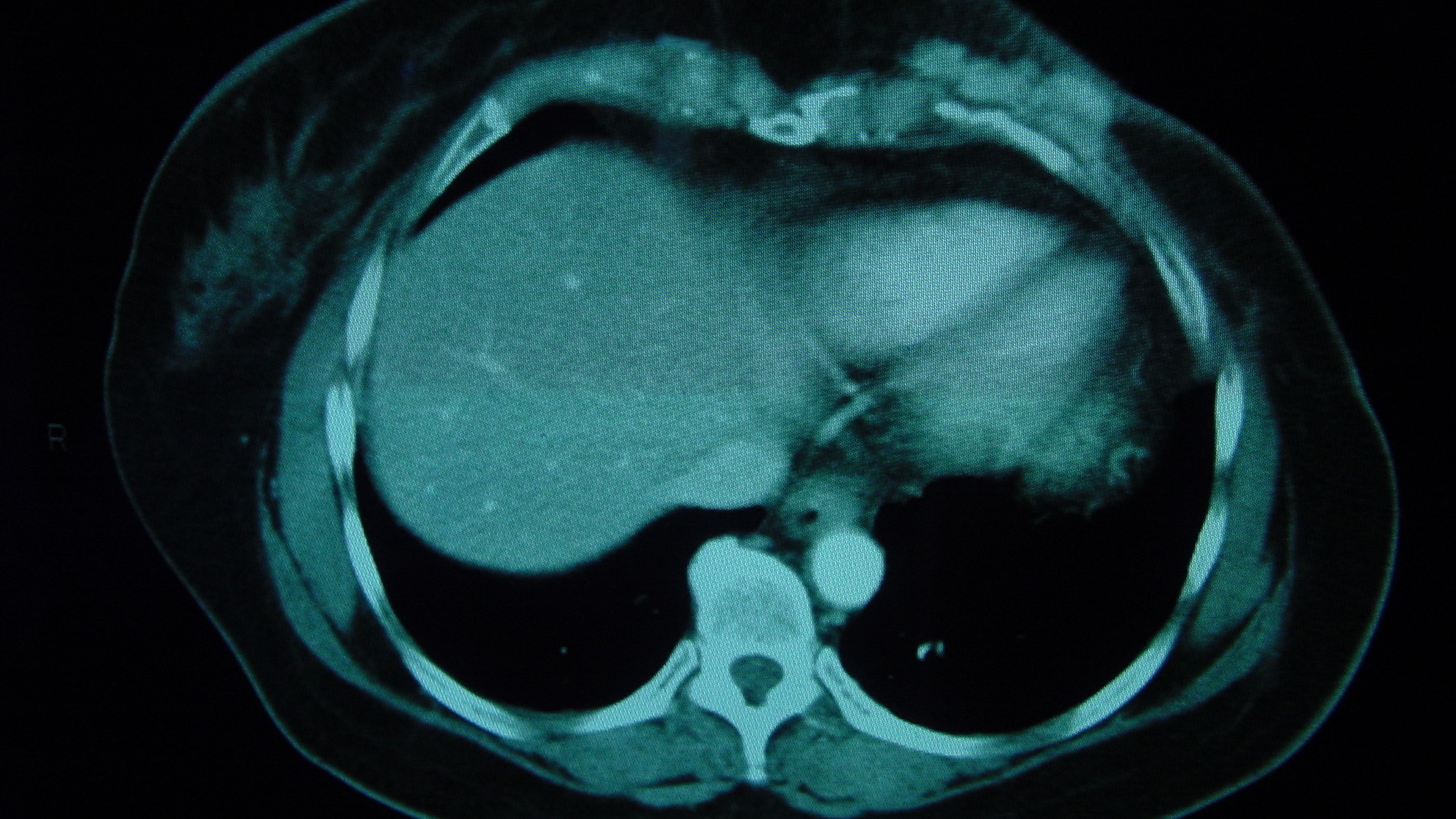 Scan of a cancerous tumor reoccurrence within a breast after a mastectomy.