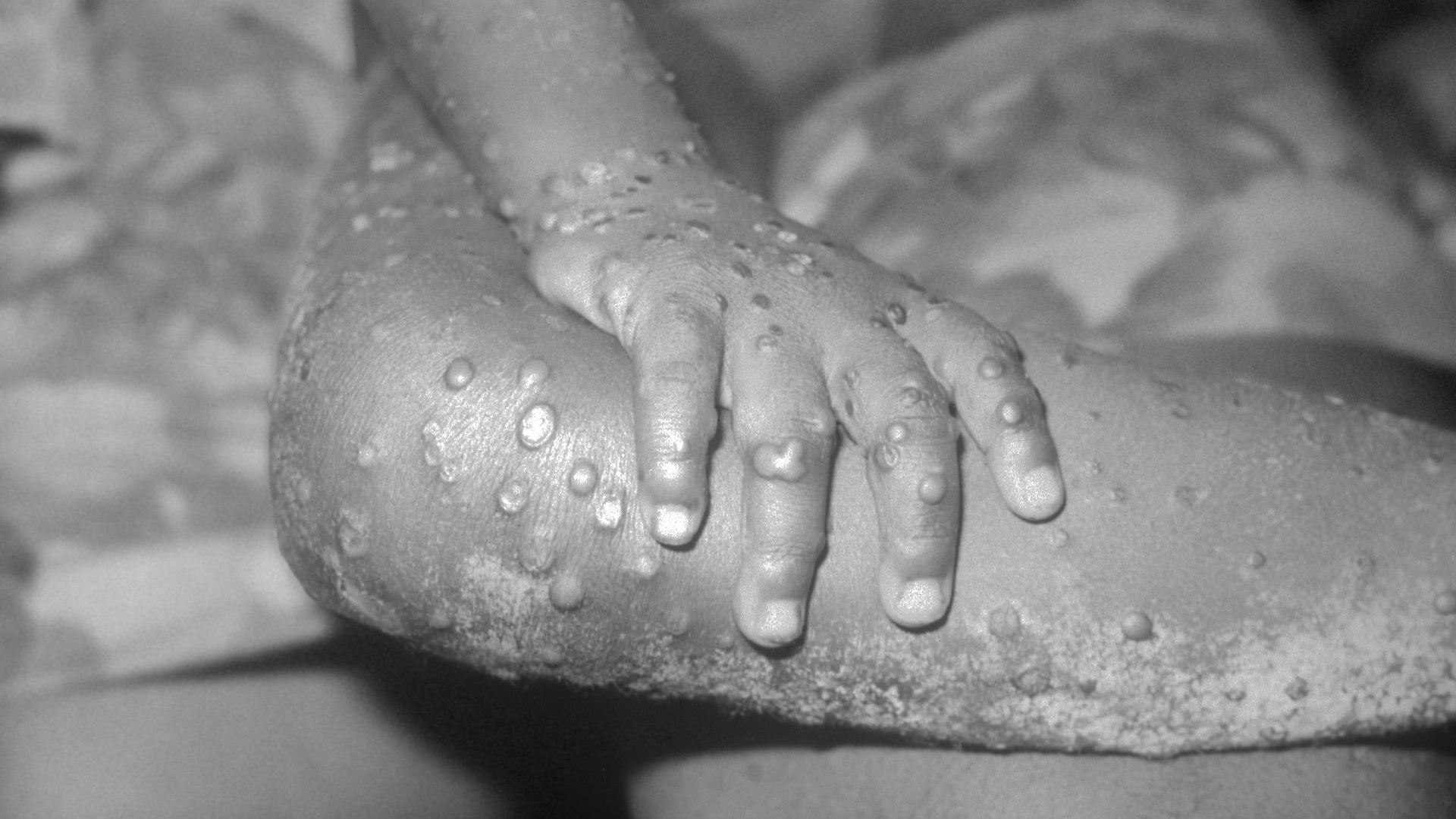 This image from 1971 depicts a 4 year-old girl in Liberia, with numerous monkeypox lesions.