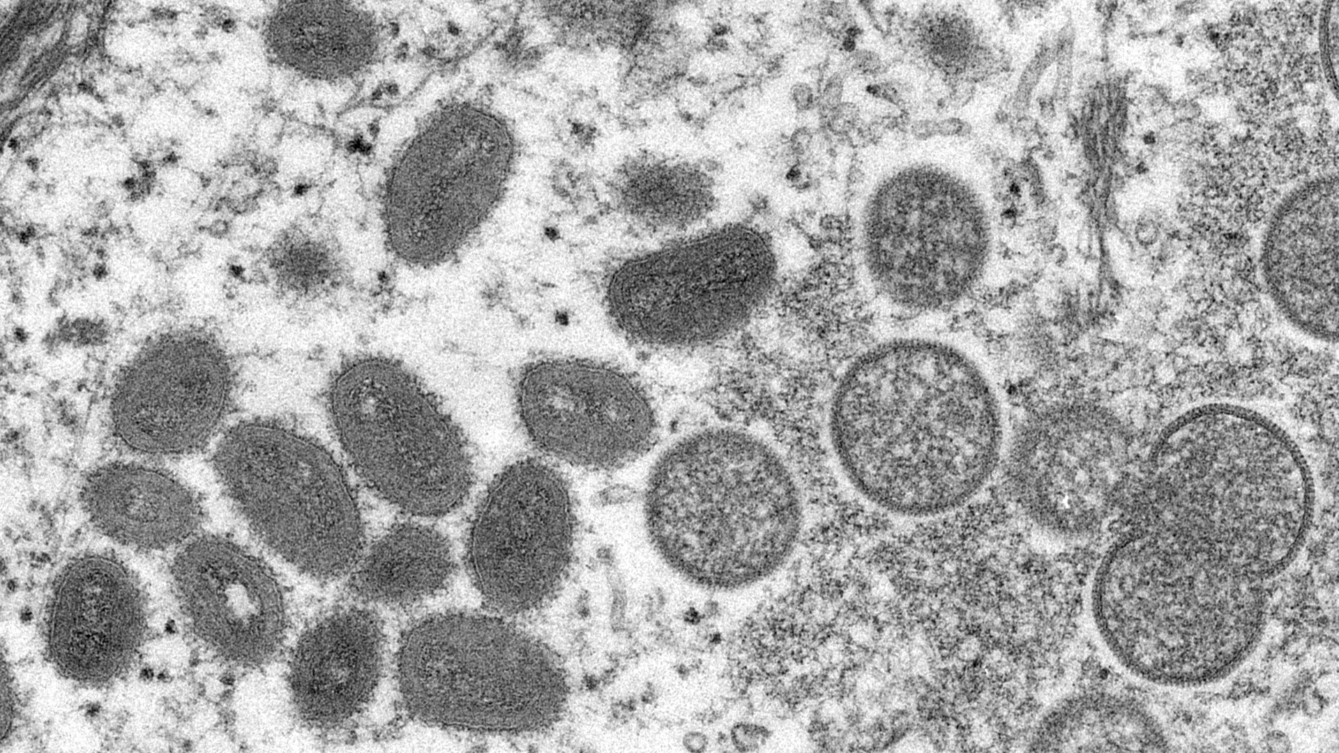 This electron microscopic image depicted monkeypox virus particles, obtained from a clinical sample associated with the 2003 prairie dog outbreak. It was a thin section image from of a human skin sample.
