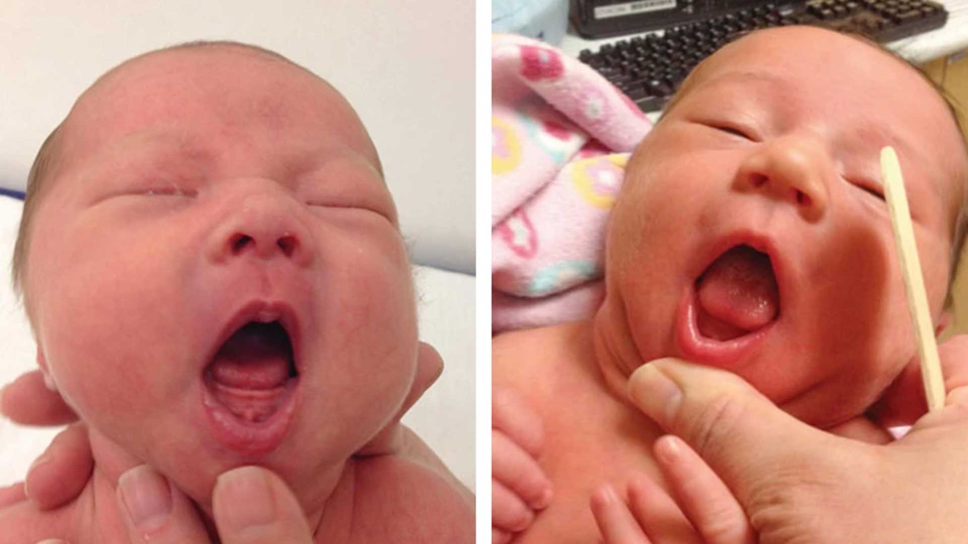 This combination of photos provided by Dr. Maya Bunik in July 2024, shows a baby with ankyloglossia where the tongue does not extend beyond the gums, left, and a baby with an indentation at the tip of a the tongue which may be a sign of ankyloglossia. On Monday, July 29, 2024, one of the largest doctor’s groups in the U.S., voiced concerns that the condition, also known as “tongue-tie” which can affect breastfeeding, is being over-diagnosed and often treated with unnecessary surgery to babies’ mouths.